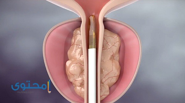 أعراض التهاب البروستاتا