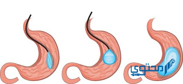 معلومات عن عملية بالون المعدة