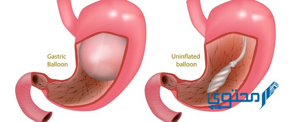 معلومات عن عملية بالون المعدة