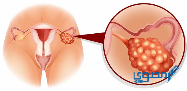 أعراض تكيس المبايض البسيط