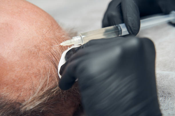 أسعار زراعة الشعر في السعودية