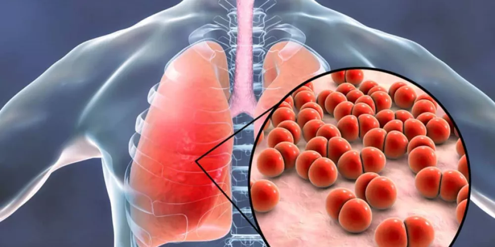 أحدث 3 طرق علاج مرض السل