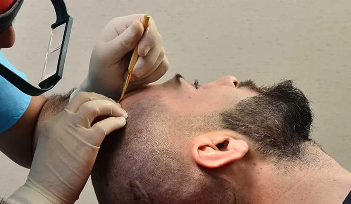 أماكن زراعة الشعر للرجال في تركيا