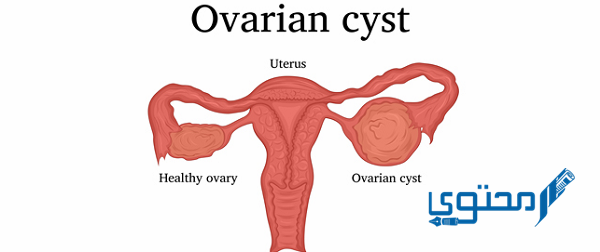 كيف ينزل كيس المبيض مع الدورة 