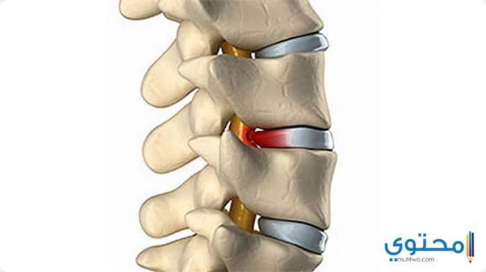 علاج الإنزلاق الغضروفى بالأعشاب