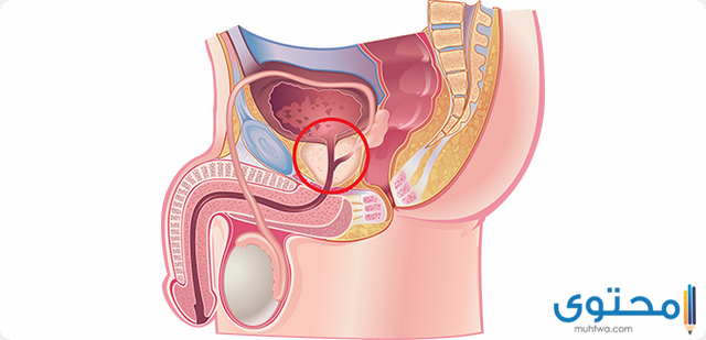 أعراض سرطان البروستاتا