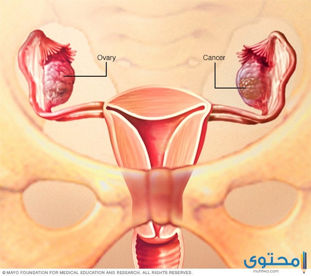 سرطان المبيض