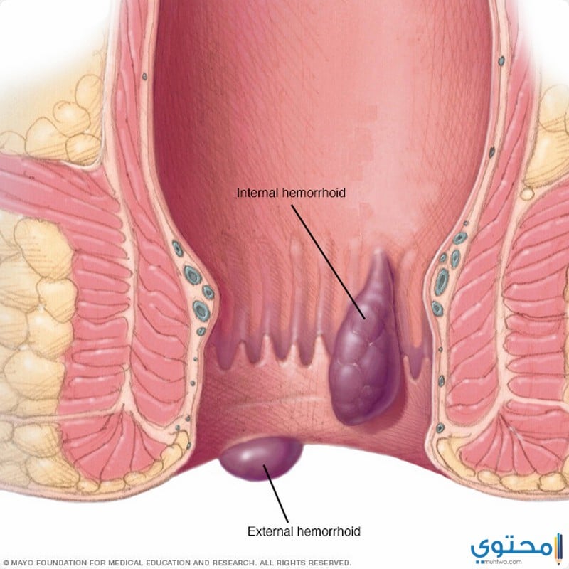 أعراض البواسير