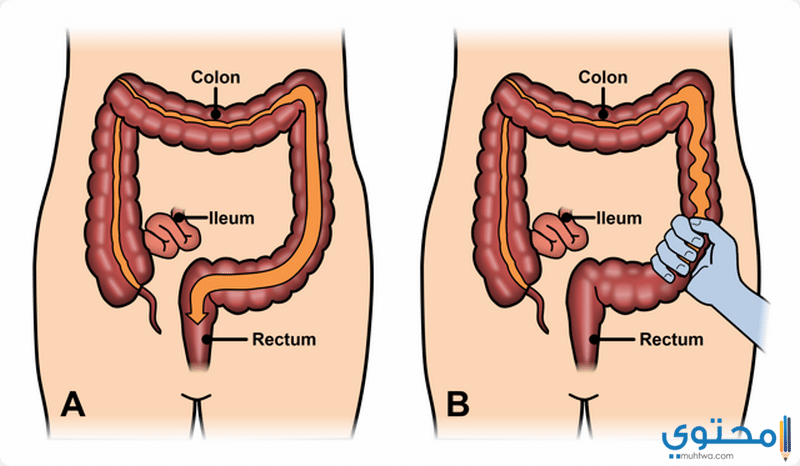الفرق بين القولون العصبي والقولون الهضمي