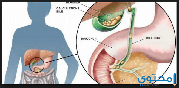 جميع أعراض التهاب المرارة
