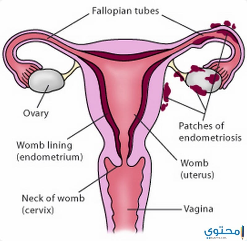 ما هي بطانة الرحم المهاجرة؟