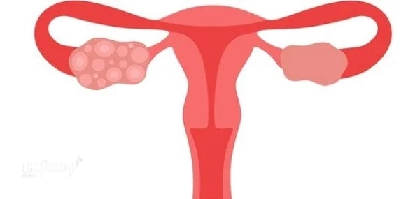 تجربتي مع متلازمة تكيس المبايض