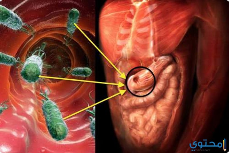 كيفية تشخيص جرثومة المعدة