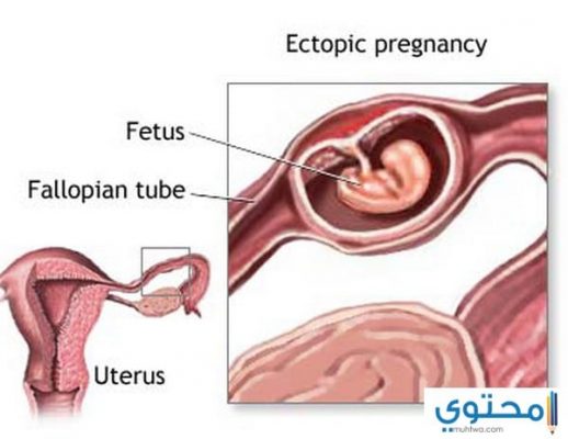 متى يكتشف الحمل خارج الرحم