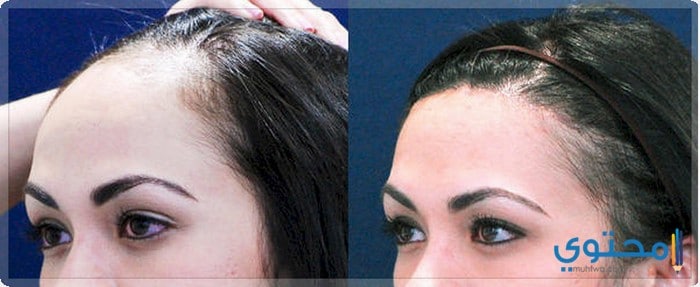 مميزاتوعيوب زراعة الشعر فى المغرب