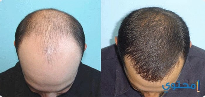 تكلفة زراعة الشعر فى الجزائر