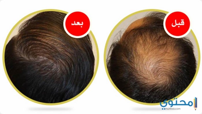  زراعة الشعر فى تركيا