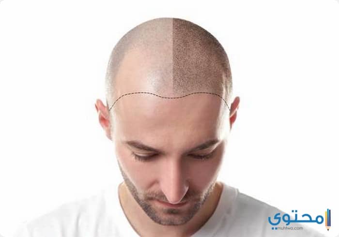 مراكز وأسعار زراعة الشعر في اسطنبول