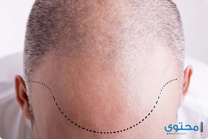  زراعة الشعر فى تركيا