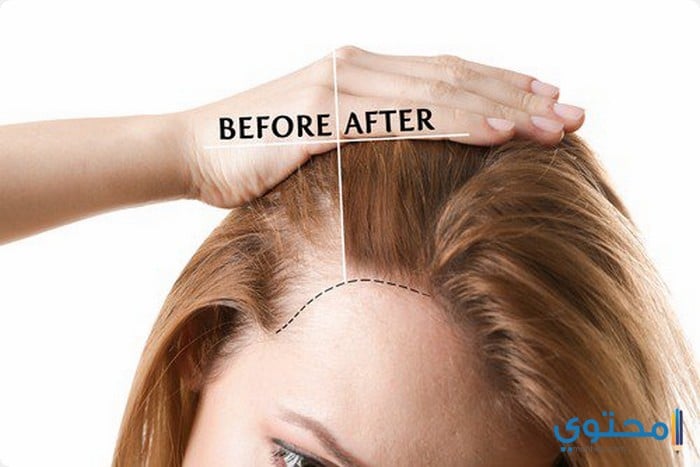 اشهر مراكز زراعة الشعر فى اسطنبول