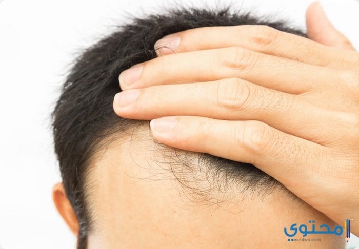 اسعار زراعة الشعر في ايران