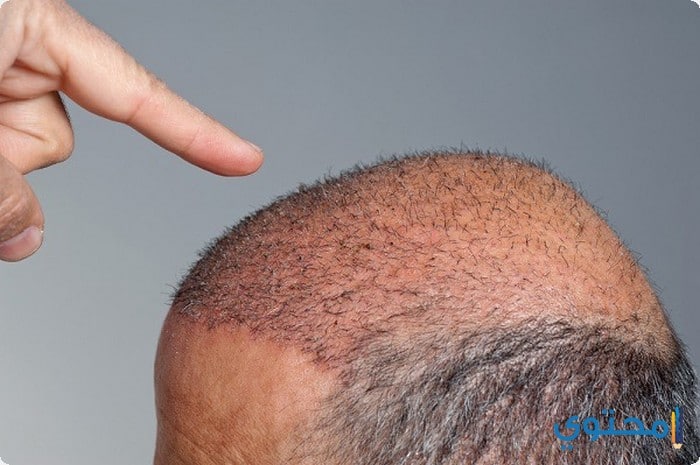   زراعة الشعر فى دبى