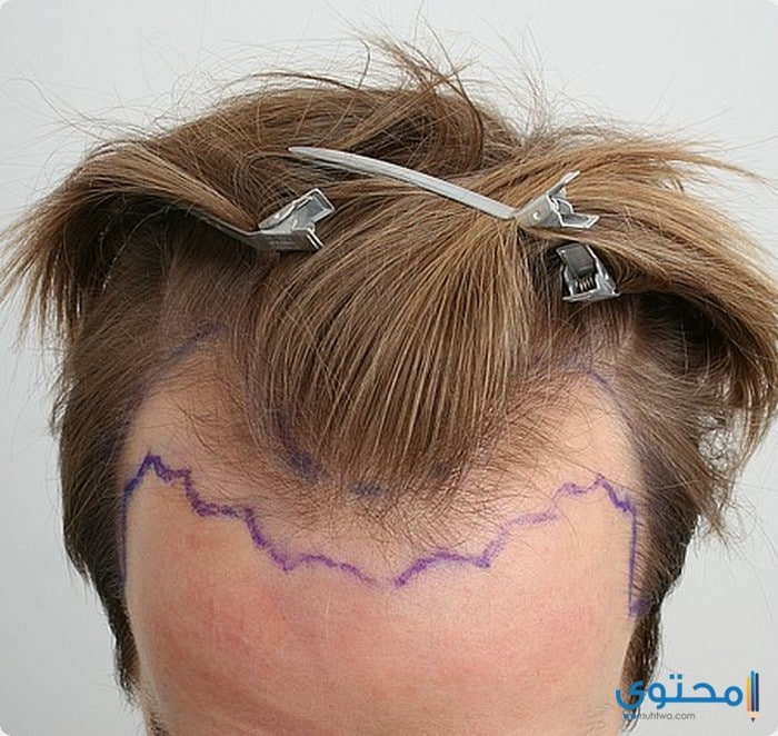  زراعة الشعر فى دبى