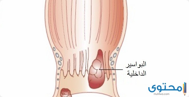 علاج البواسير الداخلية