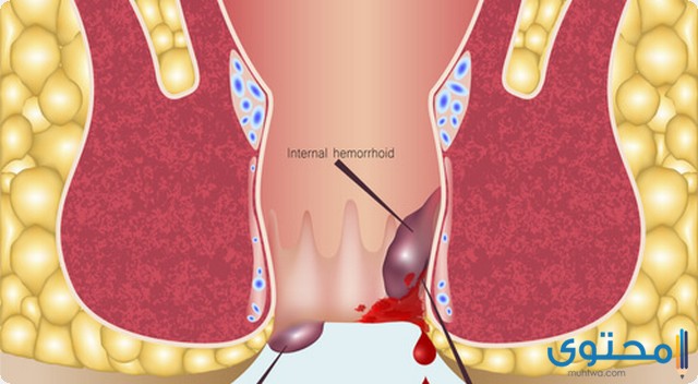 علاج البواسير الداخلية