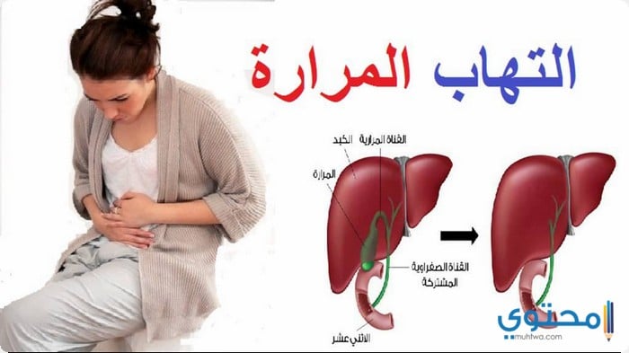 أسباب التهاب المرارة