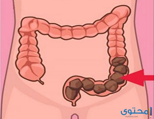 الحرقة التي تتبع خروج البراز