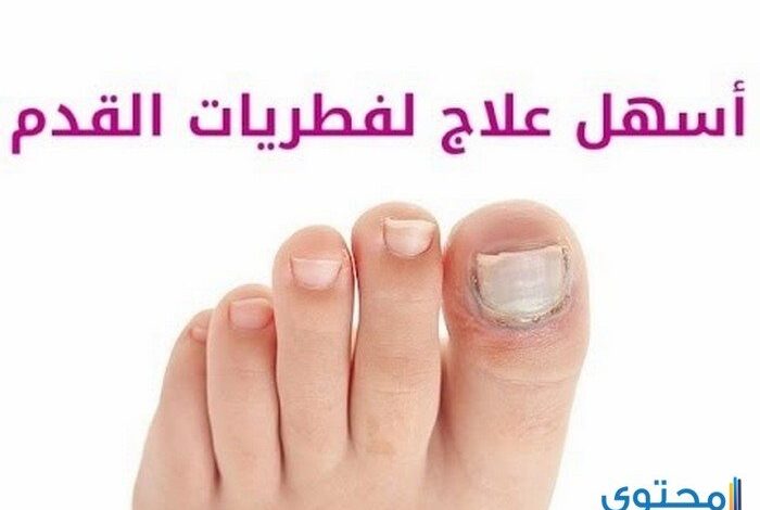 طرق طبيعية لعلاج فطريات القدم