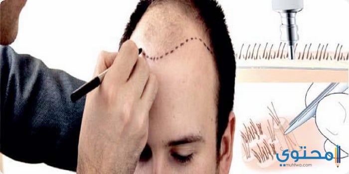 عيادات ومراكز زراعة الشعر في الكويت