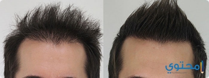 عيادات زراعة الشعر فى الكويت