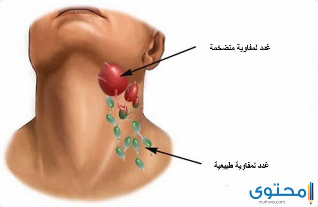 كم يستغرق علاج التهاب الغدد اللمفاوية