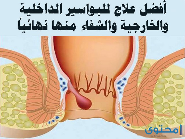 علاج البواسير