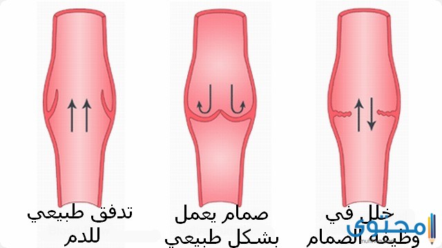 ما هو التسرب الوريدي 