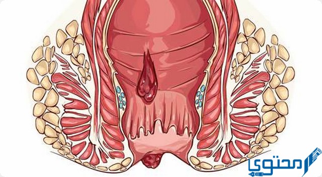 ما هي البواسير