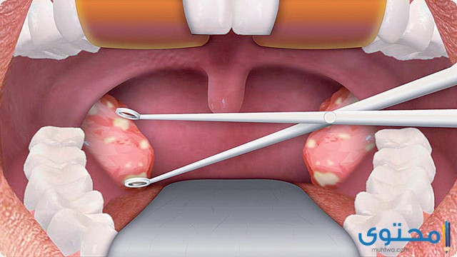 متى يلتئم جرح عملية اللوز 