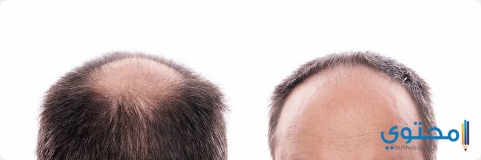 اسعار زراعة الشعر فى الأردن