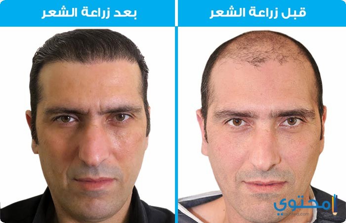 زراعة الشعر فى مصر بالإقتطاف