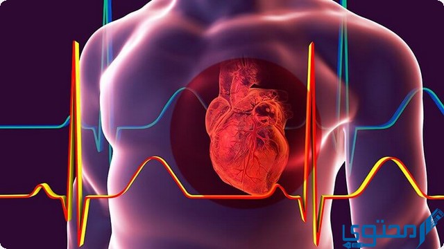 مرض متلازمة تعرج الشرايين